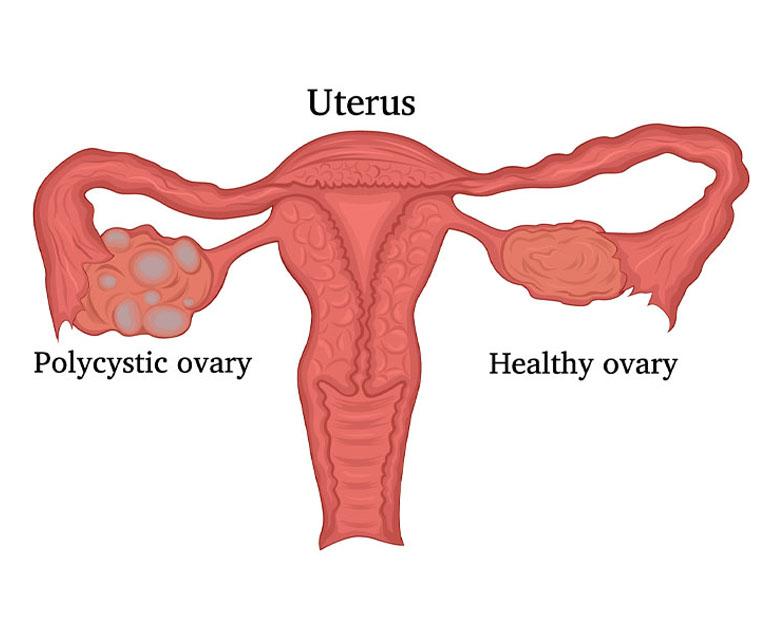 IVF Myths and Reality